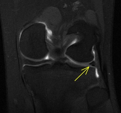 Figure 3 for case Lateral meniscus flap tear and adjacent stress fracture